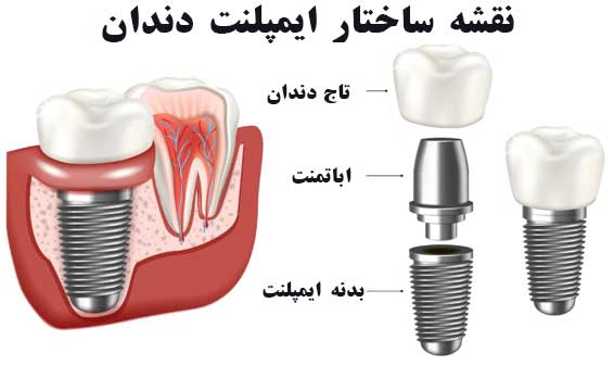 دانستنی های ایمپلنت دندان