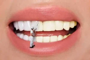 مراقبت از لمینت دندان