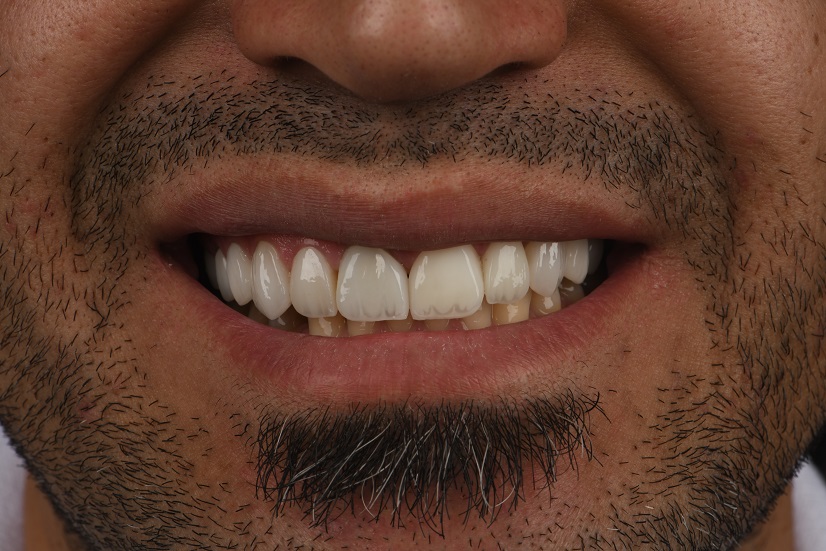 لمینیت و ایمپلنت