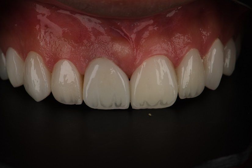 لمینیت و ایمپلنت