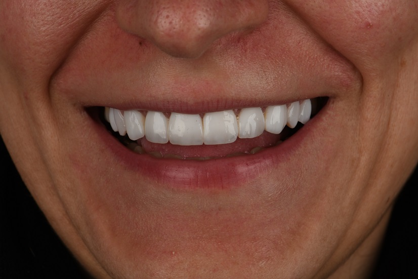 کامپوزیت به روش لایرینگ