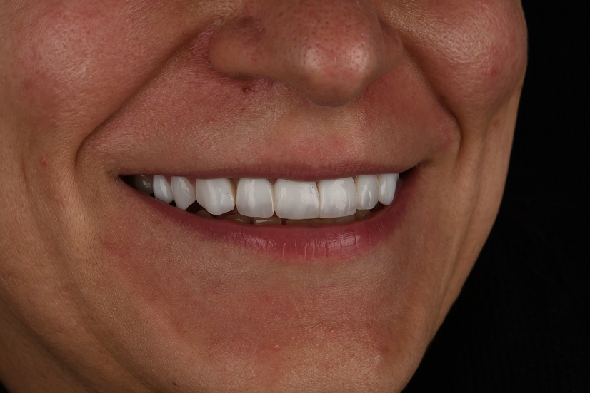 کامپوزیت به روش لایرینگ