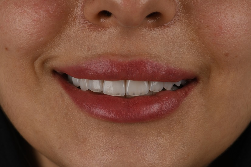 لمینیت سرامیکی لبه شیشه‌ای