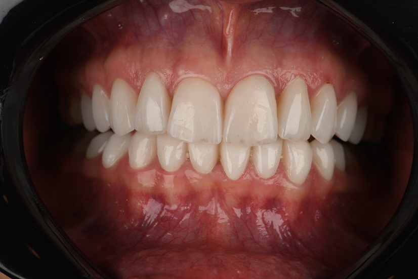 لمینیت سرامیکی لبه شیشه‌ای