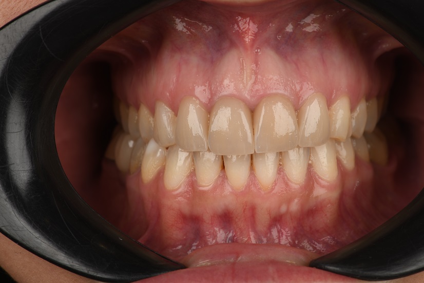 مراحل انجام لمینت دندان در کرج