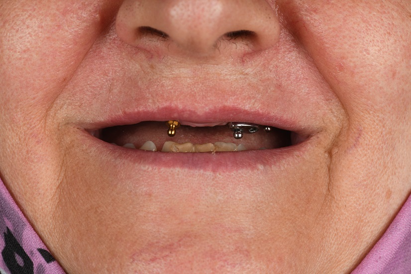 دست دندان متکی برایمپلنت