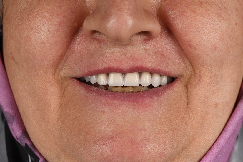 دست دندان متکی برایمپلنت