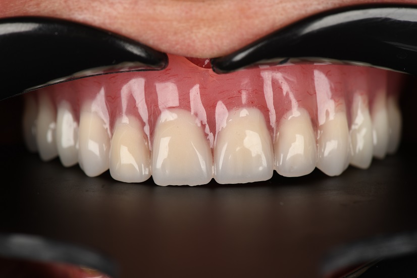 دست دندان متکی برایمپلنت