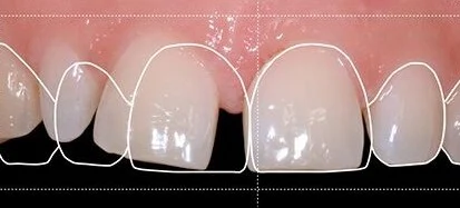 طراحی لبخند در کرج