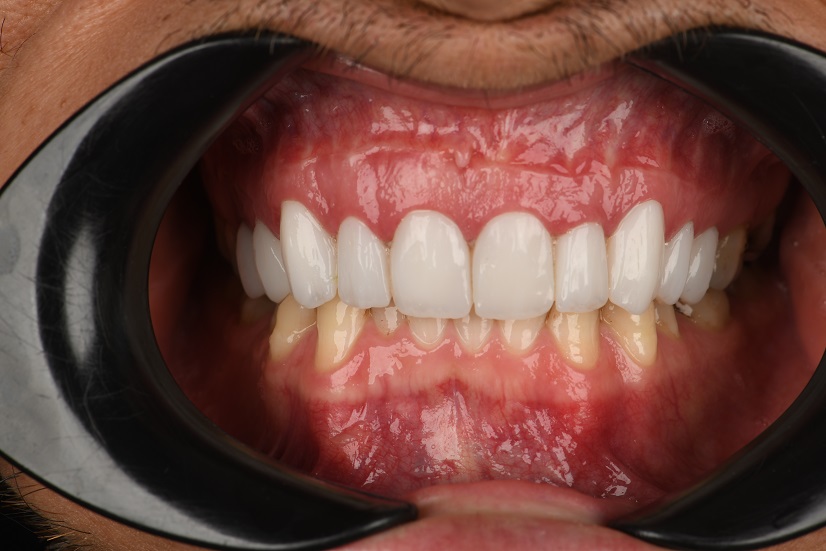 تفاوت لمینت سرامیکی و کامپوزیتی در کرج