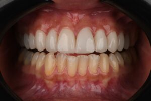 مزایای لمینت دندان در کرج