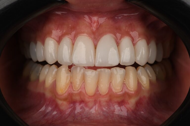 مزایای لمینت دندان در کرج